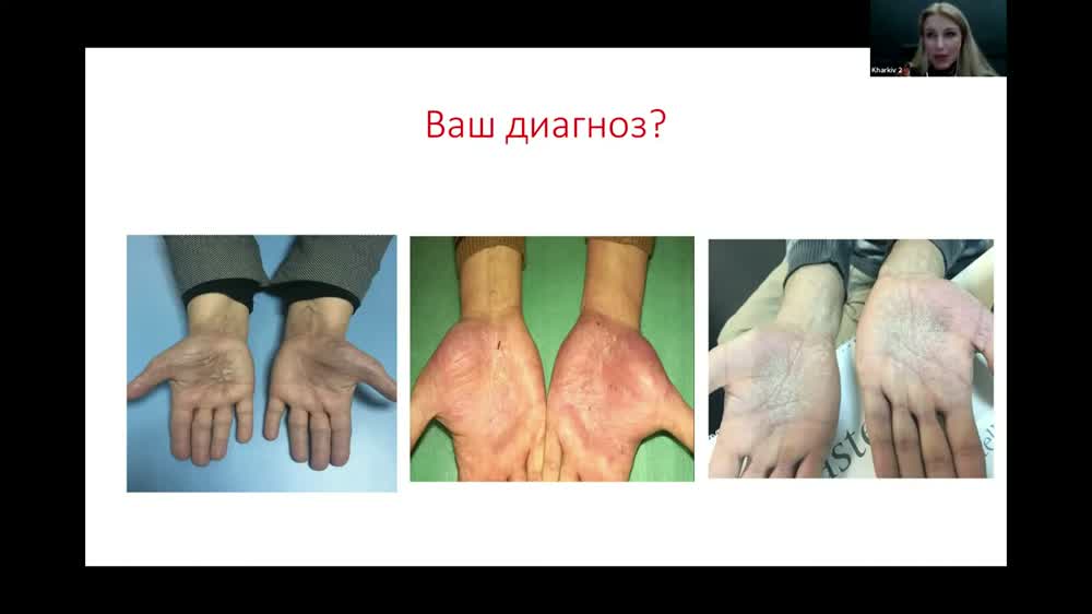 Кадр лекції Анфілової Марини Родіонівни: клінічні приклади долонно-підошовних дерматозів